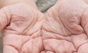 Svelato il mistero delle “dita lesse”