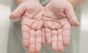 Svelato il mistero delle “dita lesse”