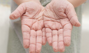 The mystery of “pruney fingers” revealed