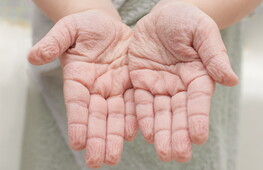 Svelato il mistero delle “dita lesse”